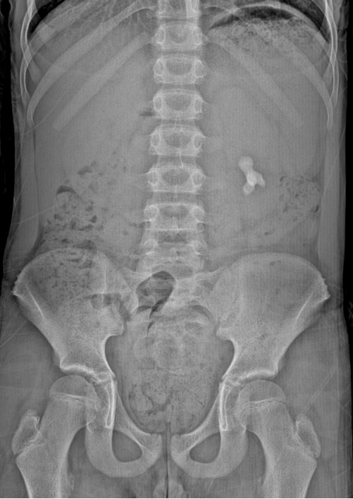 d_dorucu's tweet photo. PNL day- 3 pediatric pt 

12Fr/16Fr mini PNL with TFL 
Results: Endoscopic and floroscopic stone free
with @ytanidir @Casekerci @MarmaraUroloji 

Case 1: 10 yo pt with left renal stone https://t.co/NTDtpFRaHK
