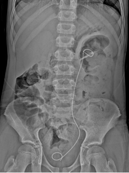 d_dorucu's tweet photo. PNL day- 3 pediatric pt 

12Fr/16Fr mini PNL with TFL 
Results: Endoscopic and floroscopic stone free
with @ytanidir @Casekerci @MarmaraUroloji 

Case 1: 10 yo pt with left renal stone https://t.co/NTDtpFRaHK