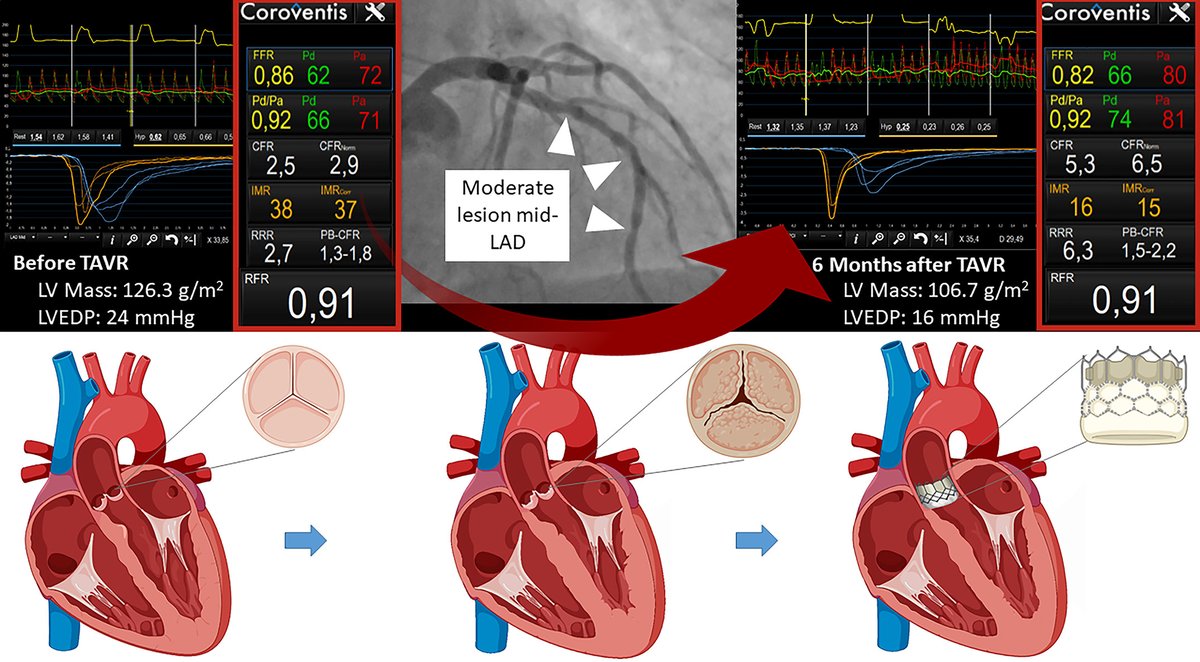 ajpheartcirc's tweet photo. Recommended Reading on Aortic Valve Stenosis 📰
The #coronary and #microcirculatory measurements in patients with aortic valve stenosis study: rationale and design
https://t.co/k2vO0MsqRN https://t.co/SLBaJviyN1