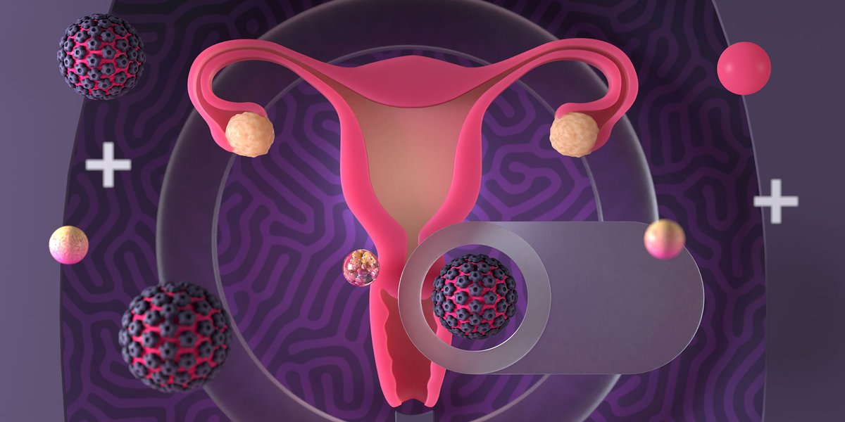 bpacnz (@bpacnz) on Twitter photo In the first article of our gynaecological cancer series, supported by Te Aho o Te Kahu, we discuss the latest on prevention, early detection and referral of patients for investigation for cervical cancer: bpac.org.nz/2022/cervical-… 
#CervicalCancer In the first article of our gynaecological cancer series, supported by Te Aho o Te Kahu, we discuss the latest on prevention, early detection and referral of patients for investigation for cervical cancer: bpac.org.nz/2022/cervical-… 
#CervicalCancer