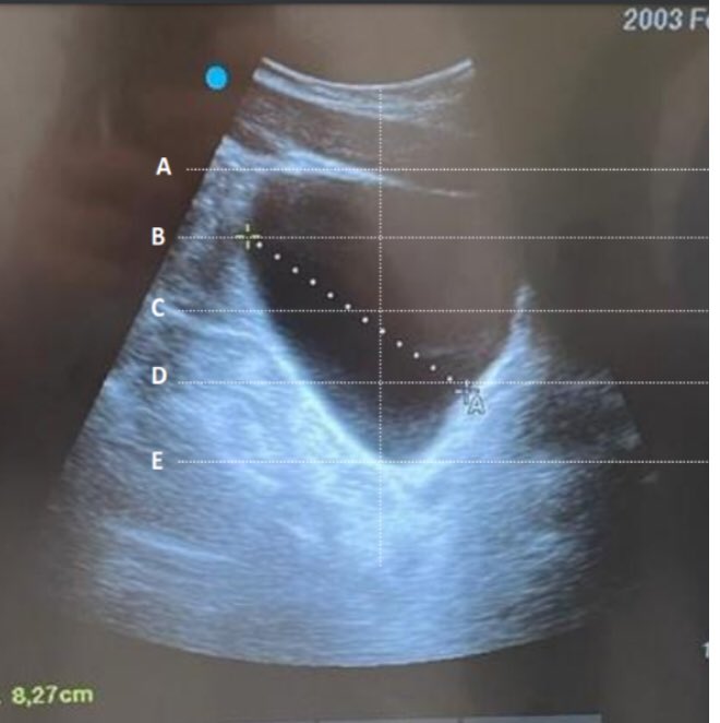 albertovillamo4's tweet photo. Patricia Calderón y el proyecto de innovación Enfermera “Mejora en Evaluación Ecográfica de Volumen Vesical con Nuevo Método de Medición” premiado con 2o áccesit en Jornada de Innovación @hospitalclinic Enhorabuena a todo el Equipo!! @gemma6316 @barnaclinic @Sonosite https://t.co/0O1soXU74p