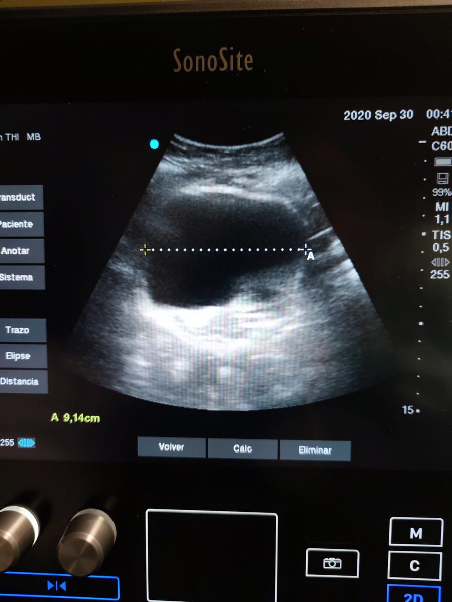 albertovillamo4's tweet photo. Patricia Calderón y el proyecto de innovación Enfermera “Mejora en Evaluación Ecográfica de Volumen Vesical con Nuevo Método de Medición” premiado con 2o áccesit en Jornada de Innovación @hospitalclinic Enhorabuena a todo el Equipo!! @gemma6316 @barnaclinic @Sonosite https://t.co/0O1soXU74p