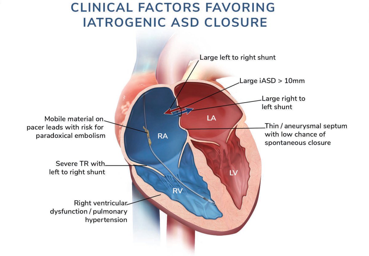 #TEER ebook highlight—Chapter 14: Evaluation of Iatrogenic ASD and Need for Closure This chapter discusses the risks of developing persistent #iASDs after the #TEER #MitraClip procedure & assessing the need for closure. ➡️ scaipro.scai.org/URL/TEEReBookT… #mitral #MitralRegurgitation