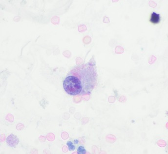 Part 2. More images. Is the N/C ratio >0.7? @JayarajGifrina @SumantaDas_7 @William28538949 @sumeyra_md @ZHouseh @DrTravisBrown @TristanRutland7 @JaylouVelez @glinglerimek @vi_monappa @AnupamaArya12 @premcharles @essel_eda @makvvlad @OKCPathguy @DrJuhlin @PoloniaAntonio @atman_ci