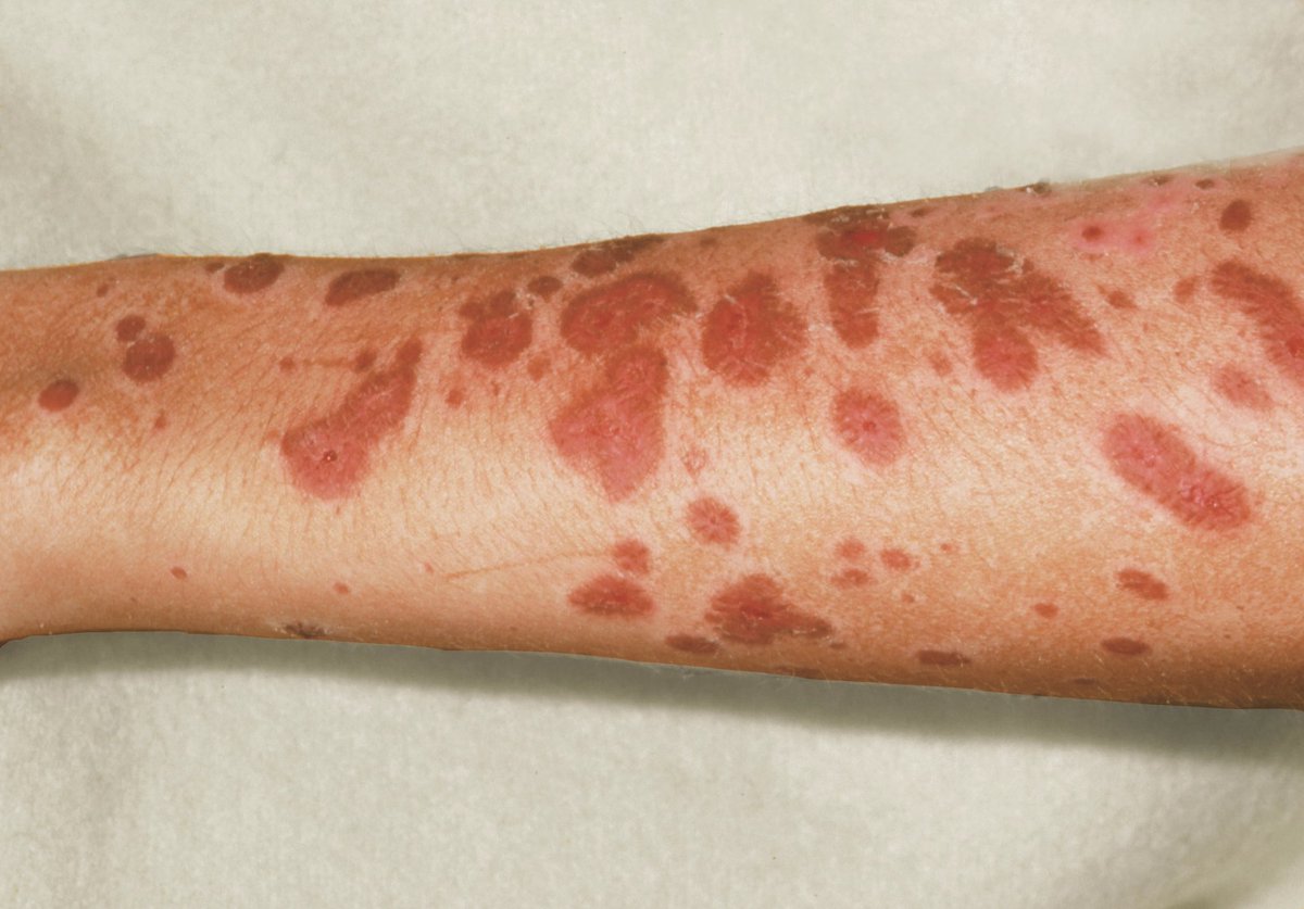 Pharma_Connect's tweet photo. 🔴 Avoid the combination of mebendazole and metronidazole due to the potential increased risk of Stevens-Johnson syndrome 
‼️ لا يُعطى دواء مترونيدازول مع دواء ميبيندازول لأنه يزود احتمالية الاصابة "بمتلازمة ستيفنز جونسون" وهي اضطراب نادر وخطير يصيب الجلد والأغشية المخاطية. https://t.co/846mmL0Sxu