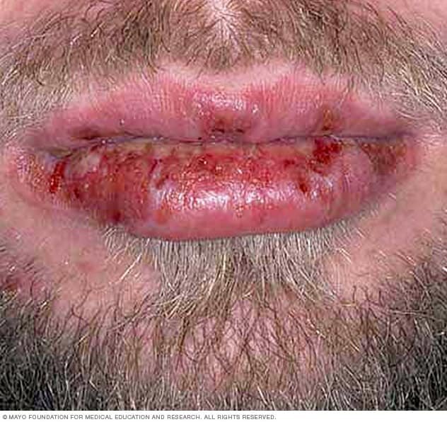 Pharma_Connect's tweet photo. 🔴 Avoid the combination of mebendazole and metronidazole due to the potential increased risk of Stevens-Johnson syndrome 
‼️ لا يُعطى دواء مترونيدازول مع دواء ميبيندازول لأنه يزود احتمالية الاصابة "بمتلازمة ستيفنز جونسون" وهي اضطراب نادر وخطير يصيب الجلد والأغشية المخاطية. https://t.co/846mmL0Sxu