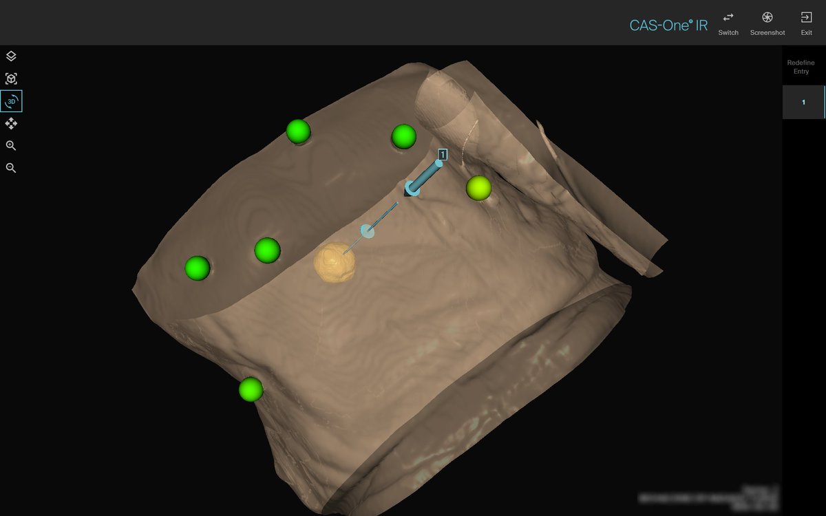 bibokandras's tweet photo. First cases with @CAScination CAS-One (performed by Pál Ákos Deák MD PhD). New level of tumor ablation. #qualityablation #irad #twittIR https://t.co/Jre91KHERT