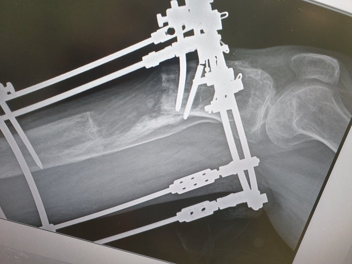 Case of septic non union distal tibia with reaction of infection and acute shortening and proximal lengthening osteotomy, pt develped procurvatum deformity due unstable ring , acute correction done of regenerate,notice the hinge position.