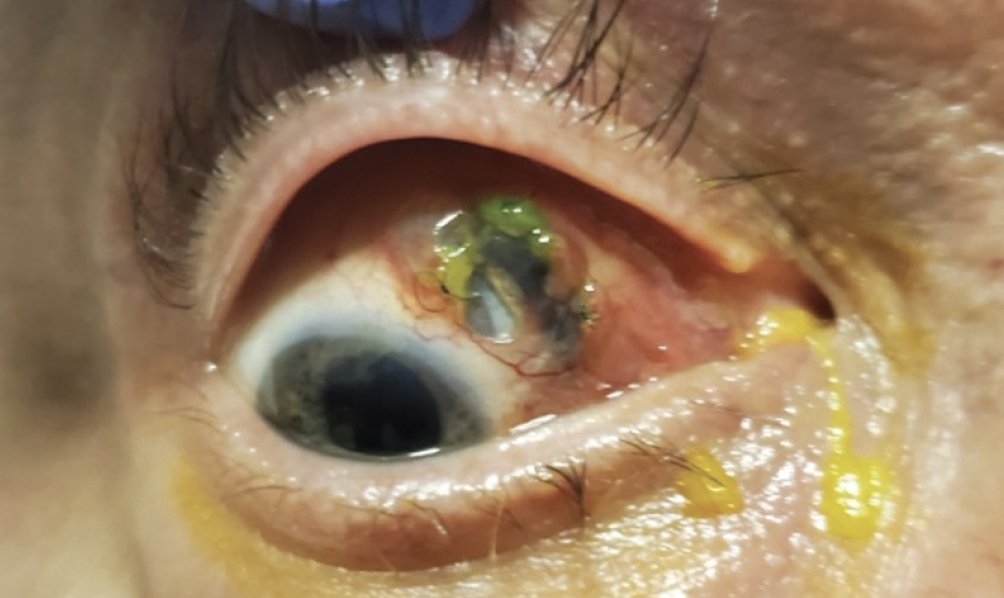RetinaToday's tweet photo. Here, surgeons present a case of an extruded silicone #scleralbuckle with associated scleral thinning and a large #conjunctival defect and the surgical steps we took to treat the patient. Continue reading in this issue of #Retina Today: https://t.co/FRoR4X2S8r https://t.co/nnkNy2E8Vi