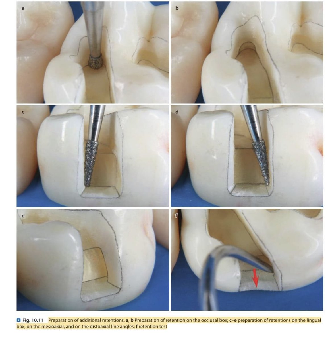 Preparation of additional retention 👇🏻