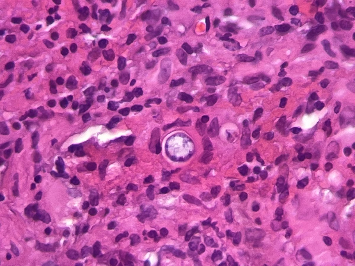 NeumopatoGdl's tweet photo. En medicina las cosas llegan en par Justo ayer compartía un caso igual // In medicine things come in pairs Just yesterday I shared a similar case #pulmopath #lung #cocci https://t.co/Wh6v5mbwd7