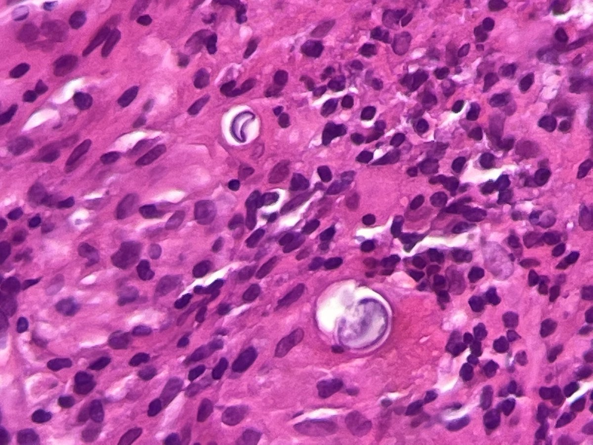 NeumopatoGdl's tweet photo. En medicina las cosas llegan en par Justo ayer compartía un caso igual // In medicine things come in pairs Just yesterday I shared a similar case #pulmopath #lung #cocci https://t.co/Wh6v5mbwd7