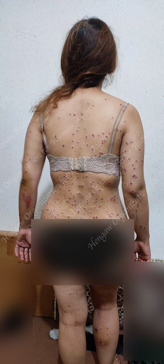 UkraineLiberate's tweet photo. The Iranian regime provides #Russia with kamikaze drones to terrorize the  #Ukrainian people. 

While their own population are in revolution against the states tyranny..

This young girl took a shotgun blast from the #Iranian forces. 

#IranRevolution2022 #RussiaisATerroistState https://t.co/i2mGYPZmaR
