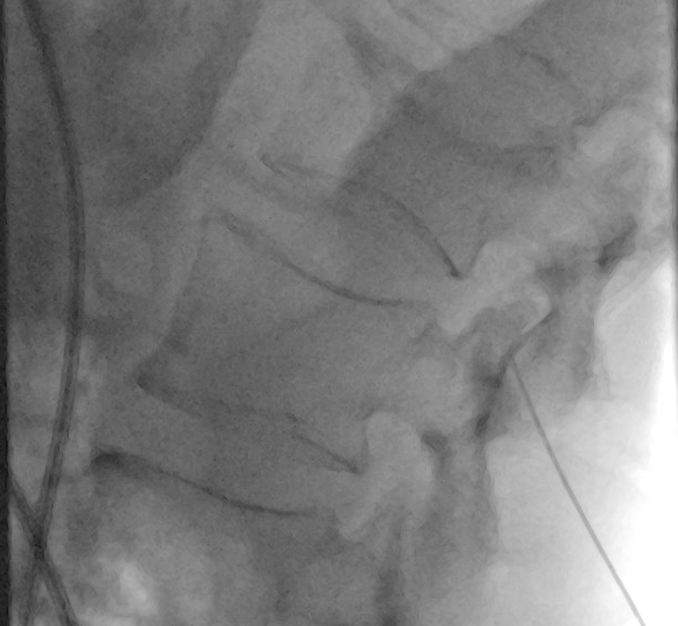 darthglader's tweet photo. The guy's respiratory status was pretty tenuous, so I gave 1 mg of versed for sedation, then did an #EpiduralBlock with 2% lidocaine and 0.5% Bupivacaine. I also injected #IntraosseousLidocaine. https://t.co/bqvuwQ0V26