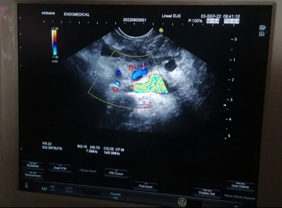 Cirugiaunilibre's tweet photo. Male 27 Y/O, with a pancreatic pseudocyst secondary to acute necrohemorrhagic pancreatitis with multiple peripancreatic collections. 
Previous percutaneous drainage with outflow of purulent secretion
Patient with surgical indication, refuses open surgery. https://t.co/WsqCAqykrI
