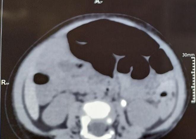 DrVCMohan's tweet photo. So with flexi ursl done with laser.
Third month post op followup, no hydronephrosis on ultrasound, patient asymptomatic
#ursl #infant #urology #drvcmohan #pediatricurology @preetihospital https://t.co/ZszneEYV7b