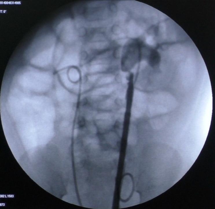 DrVCMohan's tweet photo. So with flexi ursl done with laser.
Third month post op followup, no hydronephrosis on ultrasound, patient asymptomatic
#ursl #infant #urology #drvcmohan #pediatricurology @preetihospital https://t.co/ZszneEYV7b
