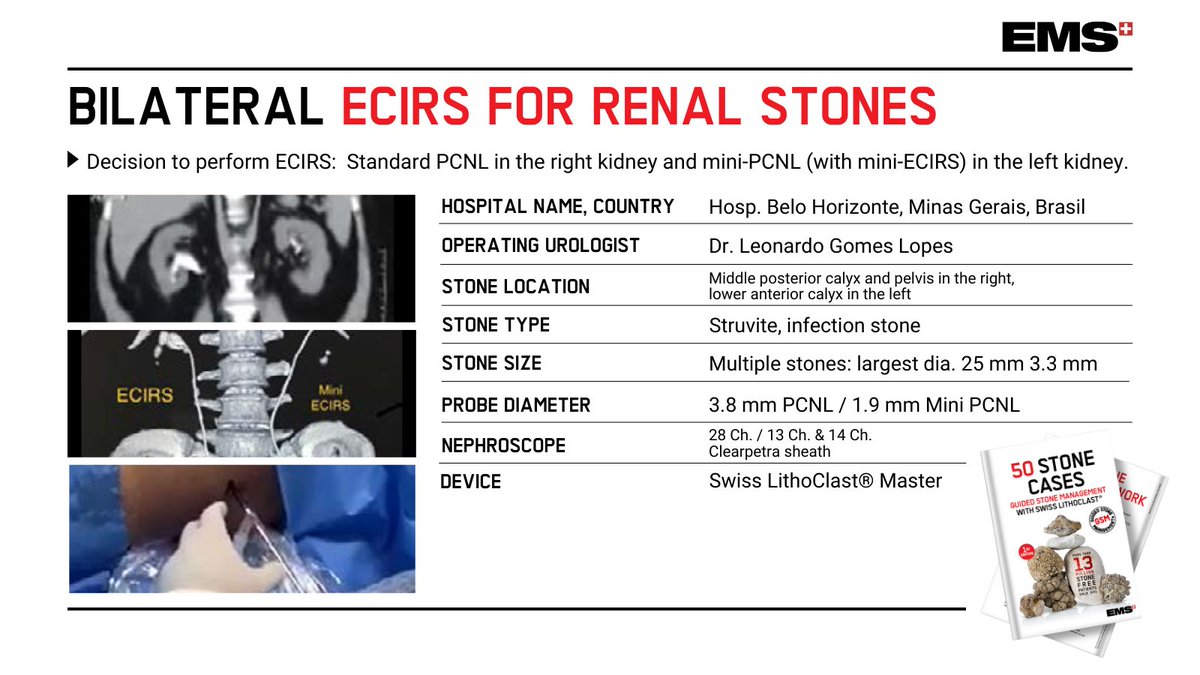 Excellent #ECIRS case study for renal pelvic stone, provided by @leogomeslopes from Brasil. Guy’s 3 stone in the right kidney with >1000 UH -- > The original #LithoClast Master for PCNL + RIRS. Interested in more cases? Contact us for our new eBook ✍ okt.to/jpWuyq