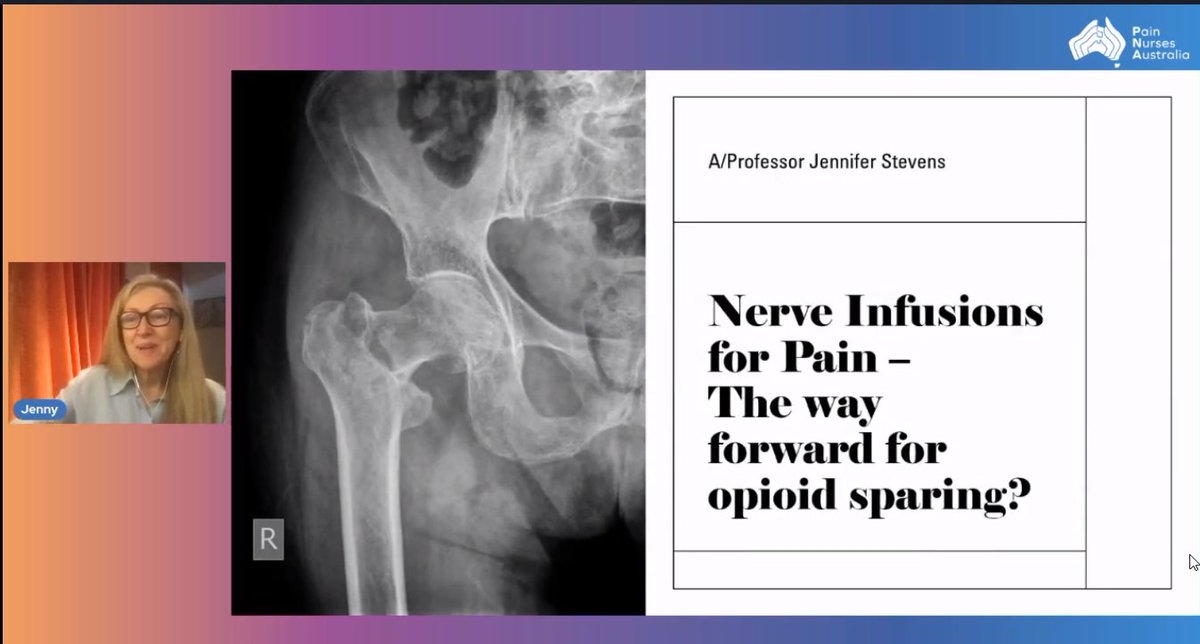 PainNursesAus's tweet photo. the wonderful Dr Jenny Stevens discussing all things great about nerve infusions helping with quality recovery

#pain #nurse https://t.co/83vCVUNlYw