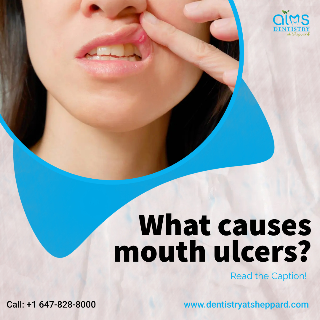aims_sheppard's tweet photo. Mouth ulcers are small sores that form on your gums, lips, tongue, inner cheeks, or palate (roof of the mouth). They can be triggered by several factors, including minor injuries, hormonal changes, emotional stress, and a weak immune system. 

#Ulcers #AIMS #aimsdentistrysheppard https://t.co/7uGzWcc878