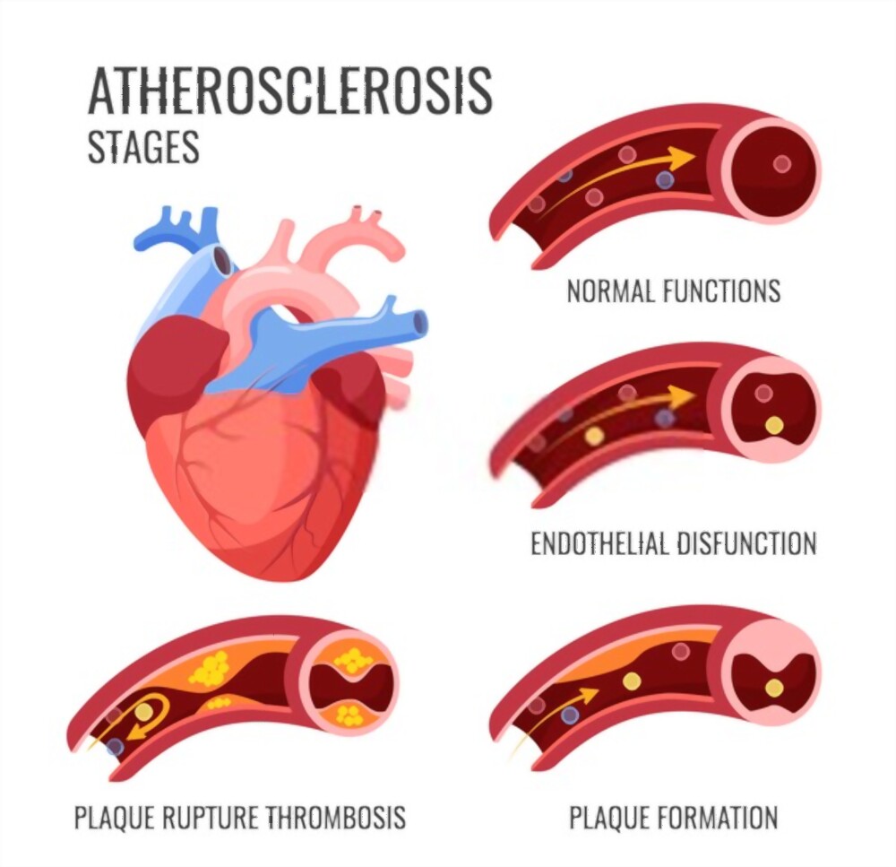Austinw9523's tweet photo. #CardiovascularMedicine2023
Submit your abstract":https://t.co/NUmPKC69Uk
#Atherosclerosis #heartattackreason #hyperventilation #MidnightsTaylorSwift https://t.co/z2KpMrQUw4