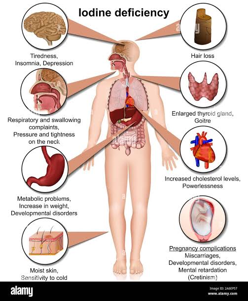samizarkoon's tweet photo. #Iodine deficiency during #pregnancy not only results in brain damage to the fetus, but also in low birth weight, prematurity and increased perinatal and infant mortality.
#WorldIodineDeficiencyDay 
#NutritionEmergency in #Balochistan https://t.co/te9I1rjYn6