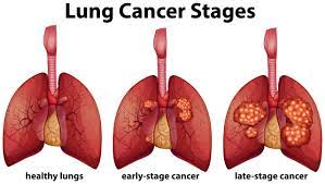 Ellie_P25's tweet image. When cancer starts in the lungs, it is called lung cancer. Lung cancer begins in the lungs and may spread to lymph nodes or other organs in the body, such as the brain. Cancer from other organs also may spread to the lungs. #lungscancer #researcher #submissionopen #doctors
