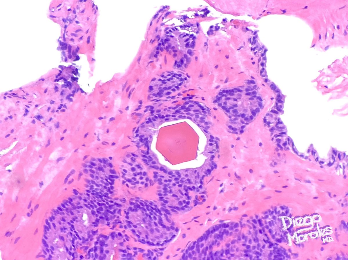 What were the odds of me finding another hexagonal corpus amylaceum in the prostate?

Well… I did. This time in PIN.

#pathtwitter #gupath #pathfulness #joyformorfology #tooprettynottoshare #freudeandermorphologie #HexagonsAreTheBestagons