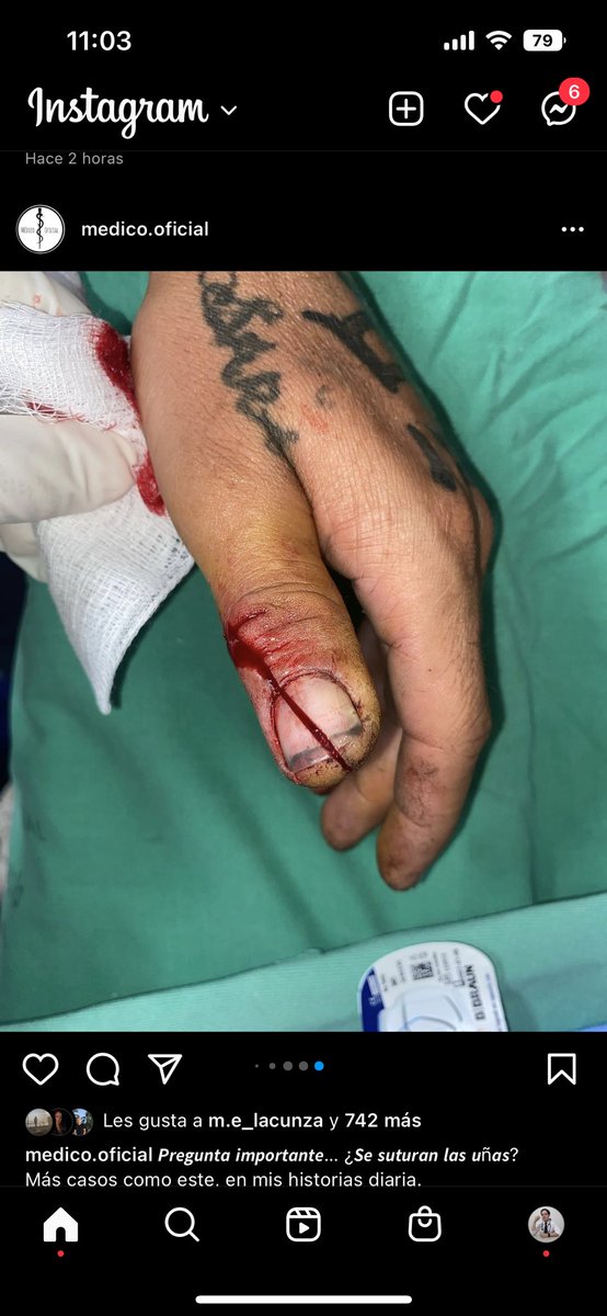 farmacotips's tweet photo. Las uñas se suturan: ¿si o no? 

Buenos días. 🫣 https://t.co/CPWBaNHRuY