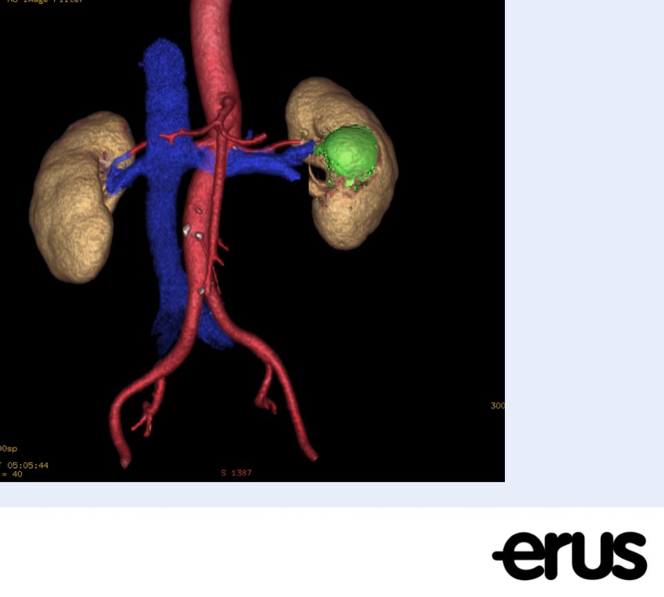 Who’s coming to #ERUS22 ? Will be performing this robotic partial nephrectomy in Barcelona. Come say HELLO if you are there! Thursday October 27 at 9:30 CET. @AlbertoBreda1 @mdstifelman @benchallacombe @AshTewariMD @JamesPorterMD @RUCgroup bit.ly/3TvZJUH