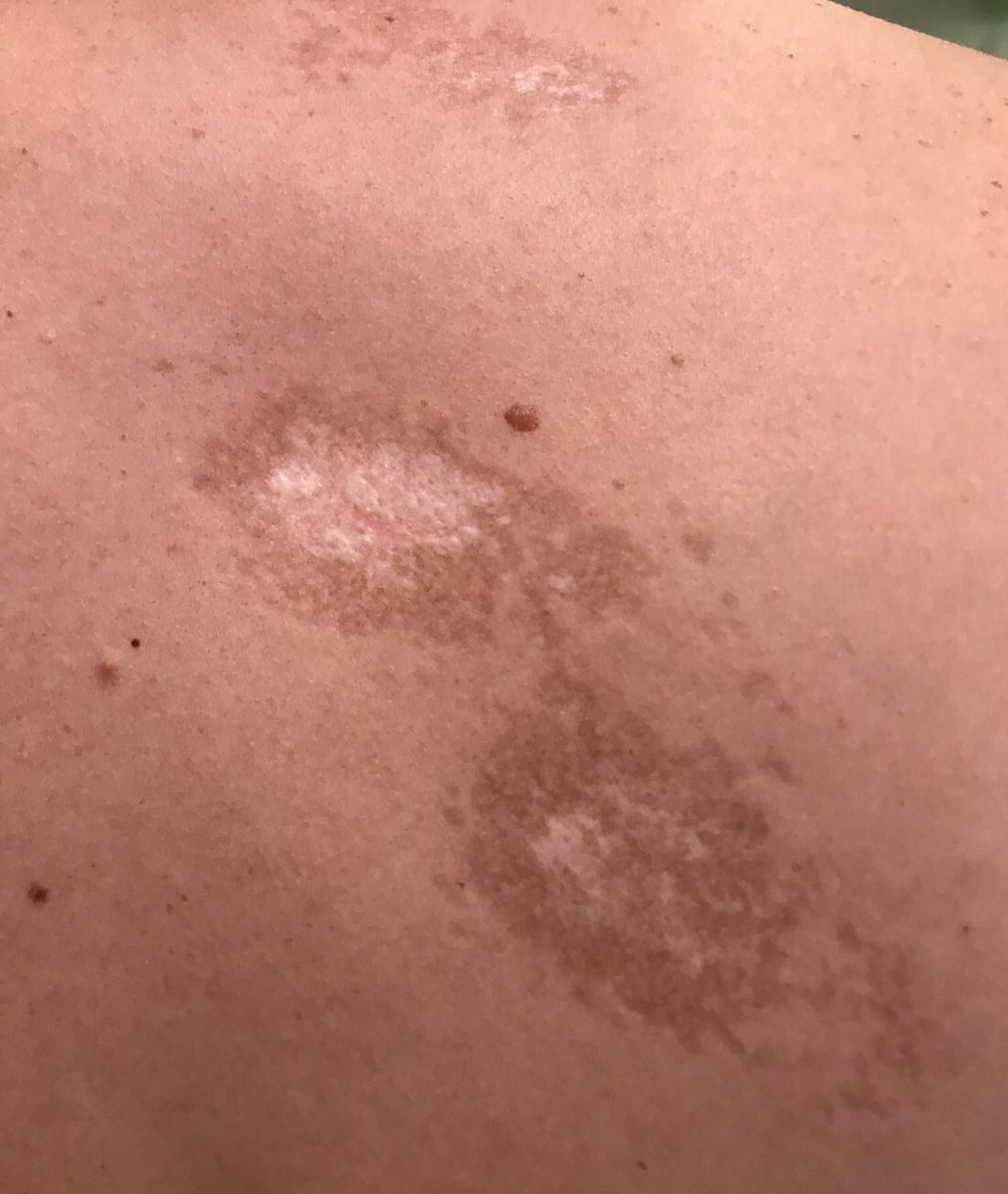 julianconejomir's tweet photo. Liquen. Curiosa su antigua etimologia.

👉 Liquen significa “chupar”.
👉 Ya Hipócrates uso este nombre por pensar que hacían eso en la piel. 
👉 Fue Wilson quien llamó así a ciertas dermatosis en el XIX.
@DermaHUVRocio https://t.co/78cO3NvKa1