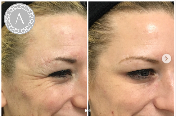 AestheticsAvika's tweet photo. Upper face Anti-wrinkle treatment at Avika Aesthetics. Before &amp; two weeks after treatment! 

#smilelines #antiageing #london #londonbeauty #eyes #beforeandafter #antiwrinkle #youngerlookingskin #naturallooks #botoxtreatment https://t.co/4ka4NRrg1V