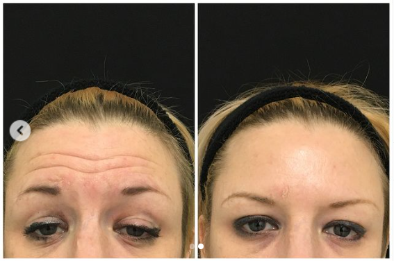 AestheticsAvika's tweet photo. Upper face Anti-wrinkle treatment at Avika Aesthetics. Before &amp; two weeks after treatment! 

#smilelines #antiageing #london #londonbeauty #eyes #beforeandafter #antiwrinkle #youngerlookingskin #naturallooks #botoxtreatment https://t.co/4ka4NRrg1V