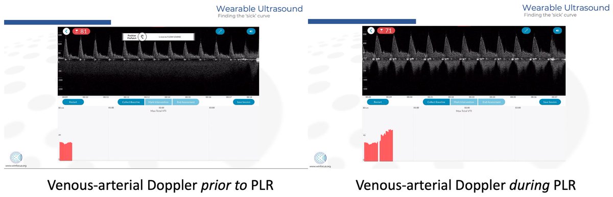 WINFOCUS's tweet photo. #WINFOCUS22 world #POCUS congress w/@TrEmatus sneak-peak of excellent lecture(re)s; 
Dr.JonEmileKelly, ”Hemodynamics &amp; Wearable Ultrasound”,3DEC@9:40

https://t.co/88SuTRrjt0 https://t.co/pw854eXNZ7