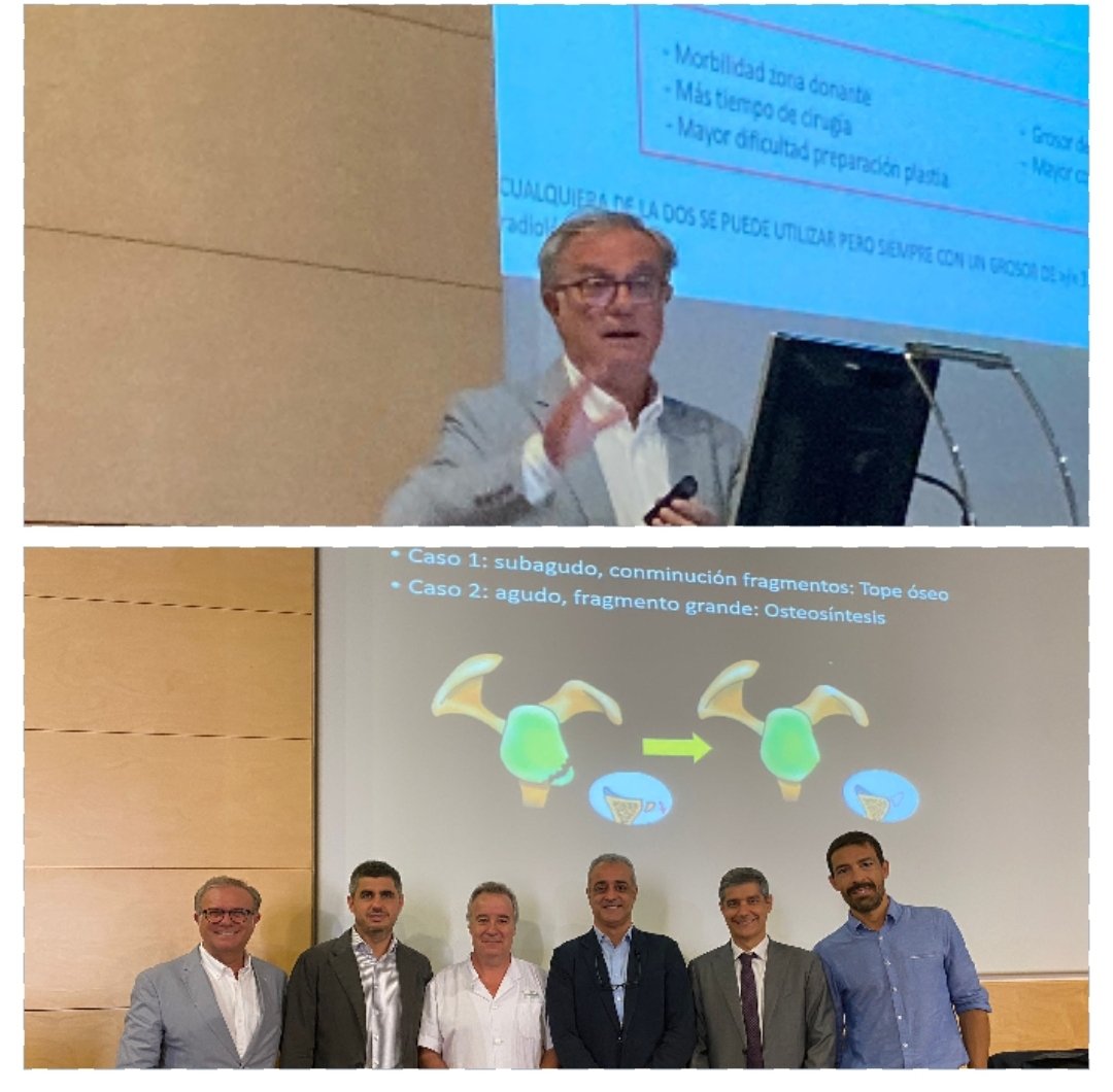 Hablando, debatiendo, discutiendo... sobre la inestabilidad y lesiones del manguito rotador irreparable en el hospital Clinic Barcelona en el Shoulder 360 organizado por el <a href="/drsergisastre/">Dr. Sergi Sastre</a> y @SmithNephew_esp 
Gran jornada de hombro 
Enhorabuena a todos