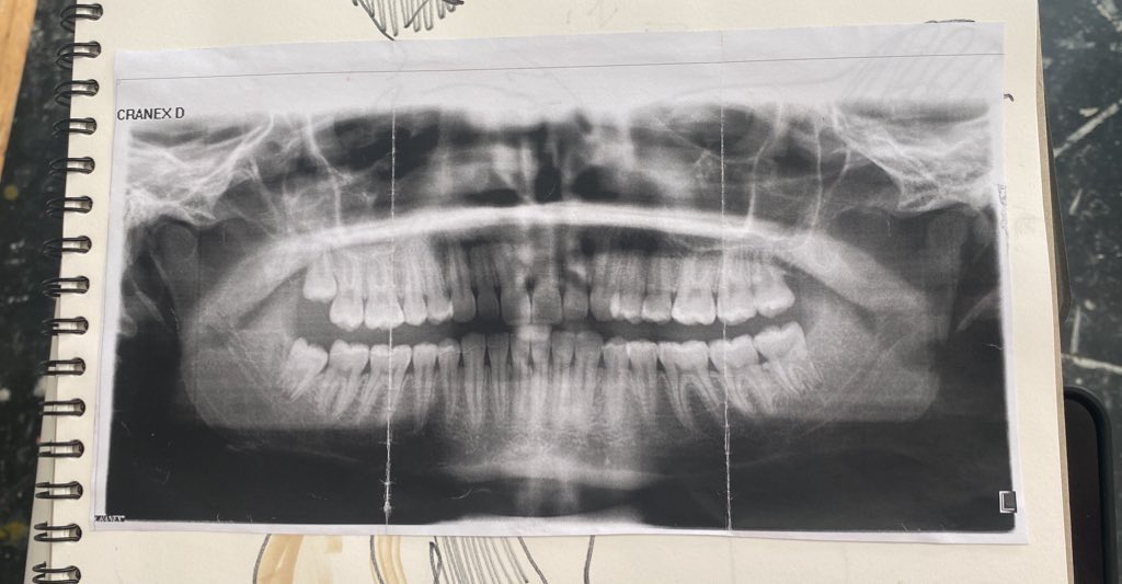rolllypoly's tweet photo. my teeth https://t.co/GiiaRRt2lf