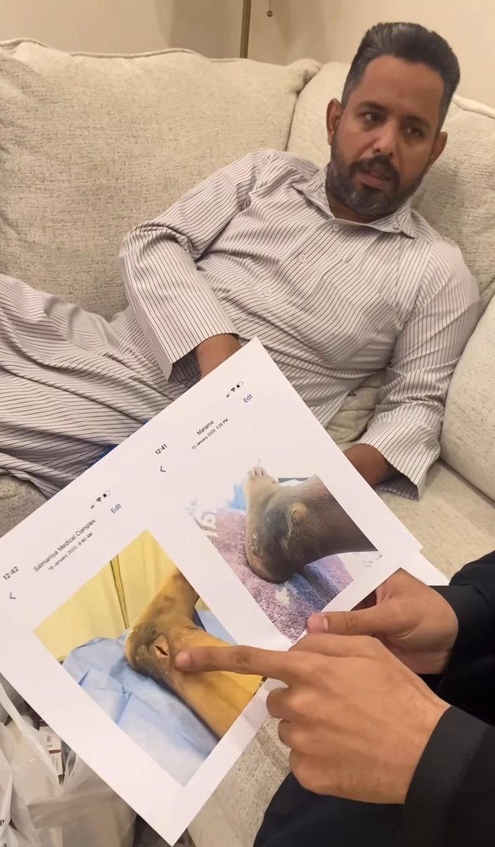 mohd_3bdulaal's tweet photo. أقسم بالله محتار شنهو أكتب عن حالة
حبيب المصاب بمرض #السكلر ولديه مشكلة
في القدمين منذ 4 سنوات! هل تنتظر وزارة الصحة الوصول لمرحلة بتر القدمين؟
ما تعلمتون من إهمال حالة الشابة التي بُترت قدميها والآن هي على كرسي متحرك.!
ساهم بالنشر لعلها تصل لمن في قلبه رحمة
وانسانية #أنقذوا_حبيب https://t.co/Try090svWG