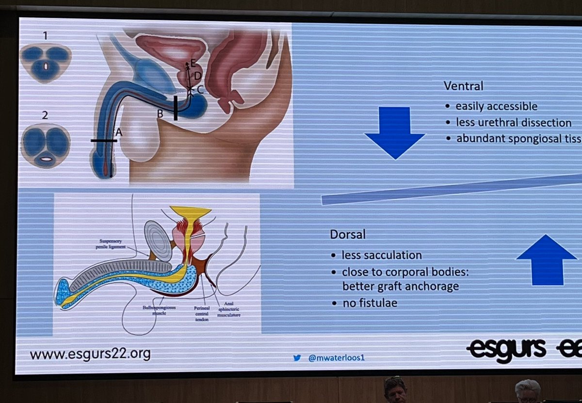 Day 2 of #esgurs22: ‘the urethra’: fixing connections (fistula repair), removing bulges (diverticles) and re-widening narrowed urethra (urethroplasty). Informative discussions and live surgeries. New techniques picked up! @hospital12Oct @Uroweb thanks for the great organisation!