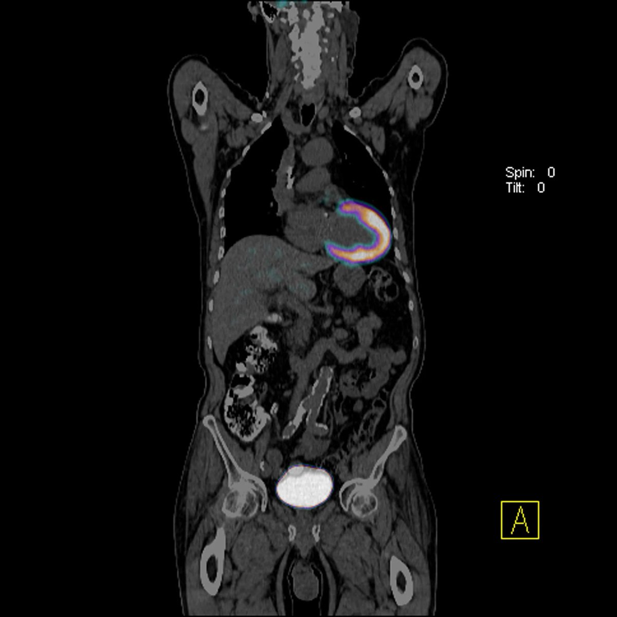VLSorrellImages's tweet photo. #JADIL
Our Advanced Cardiac Imaging ACI program took another major step forward yesterday as we launched our Cardiac PET program. Another phenomenal collaboration between CV & Radiology.
@GillKentucky @Kentucky_Cards @UK_HealthCare https://t.co/p6YSp8QzsF