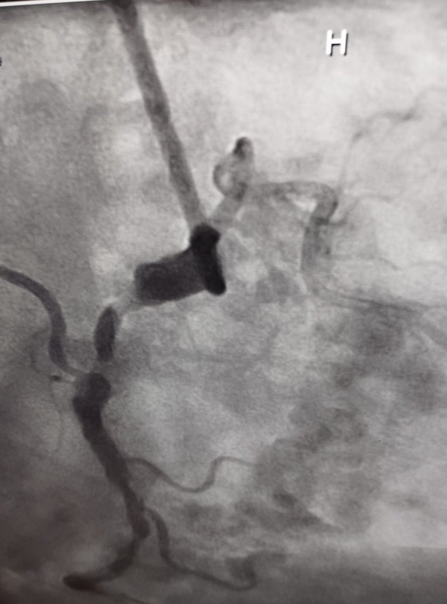 Primeiros casos de #Orbital em Portugal no Hospital Santa María.

Agradecemos a toda a equipa de #hemodinâmica, especialmente ao Dr. Pedro Pinto Cardoso por fornecer as imagens.
#BringingToolsForExcellence Cardiovascular Systems, Inc.