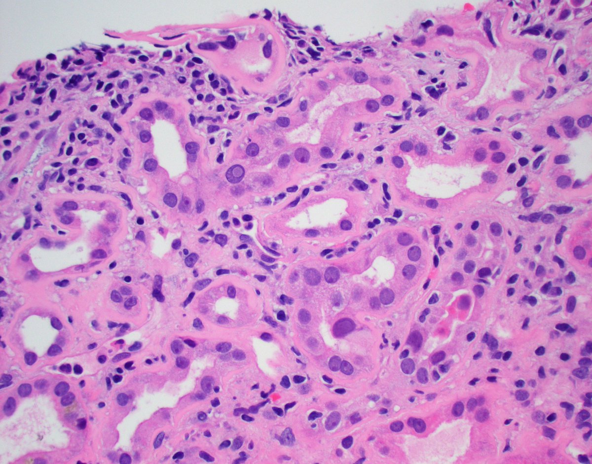 A not so subtle case of polyoma virus (BK) nephropathy. Abundant viral particles visible by EM. Conspicuous viral inclusions by light microscopy. #renalpath #pathtwitter