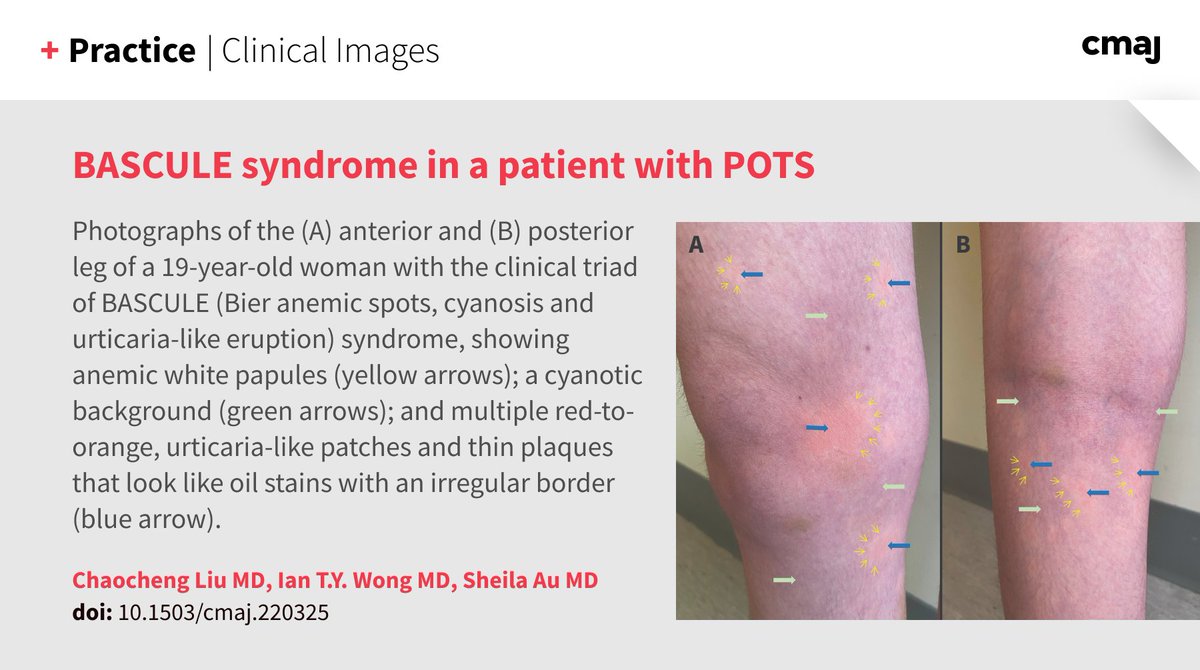 BASCULE (Bier anemic spots, cyanosis and urticaria-like eruption) syndrome is diagnosed clinically and associated with orthostatic syndromes such as postural orthostatic tachycardia syndrome (POTS).

Learn more: cmaj.ca/lookup/doi/10.…
<a href="/harryliumd/">Harry Liu</a> <a href="/dermdrwong/">Ian T.Y. Wong, MD, FRCPC</a> #dermatology