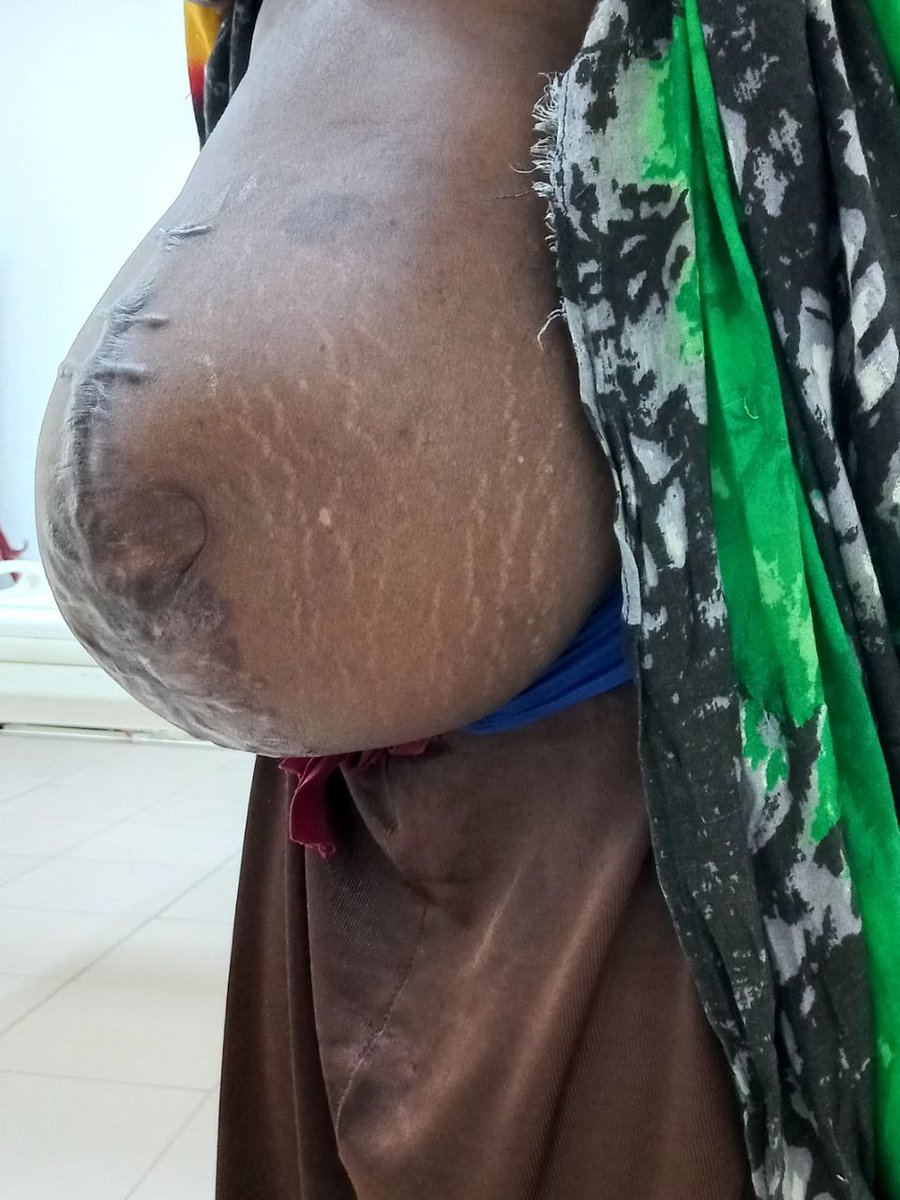 AmanuelTebikew's tweet photo. Today we teamed up with General surgery and did an exciting "component separation abdominal wall reconstruction with retrorectus mesh repair" surgery for a patient with huge ventral incisional hernia. 🙏
#surgery
#plasticsurgery
#hernia
#componentseparation
#Ethiopia
#jigjia https://t.co/hjmz8bVLFt