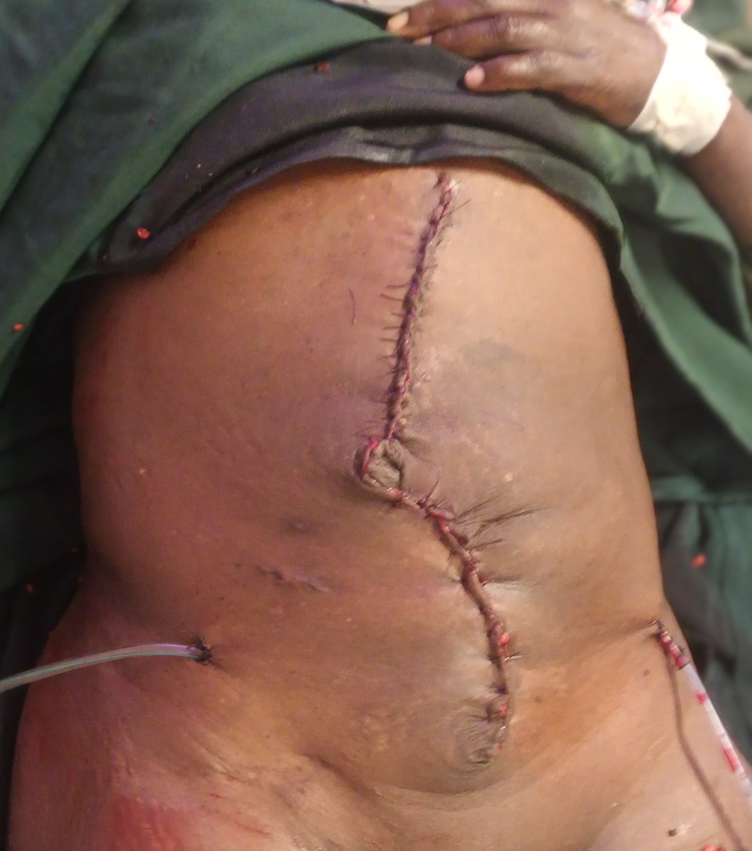 AmanuelTebikew's tweet photo. Today we teamed up with General surgery and did an exciting "component separation abdominal wall reconstruction with retrorectus mesh repair" surgery for a patient with huge ventral incisional hernia. 🙏
#surgery
#plasticsurgery
#hernia
#componentseparation
#Ethiopia
#jigjia https://t.co/hjmz8bVLFt