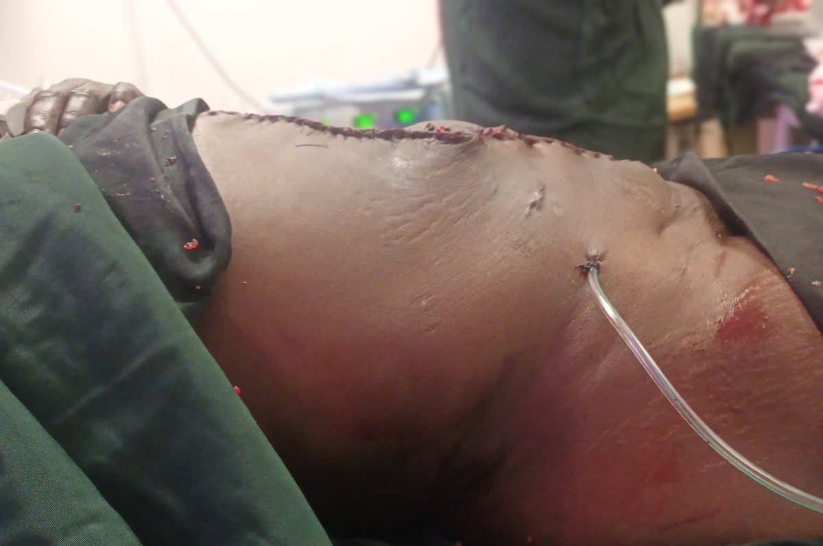 AmanuelTebikew's tweet photo. Today we teamed up with General surgery and did an exciting "component separation abdominal wall reconstruction with retrorectus mesh repair" surgery for a patient with huge ventral incisional hernia. 🙏
#surgery
#plasticsurgery
#hernia
#componentseparation
#Ethiopia
#jigjia https://t.co/hjmz8bVLFt