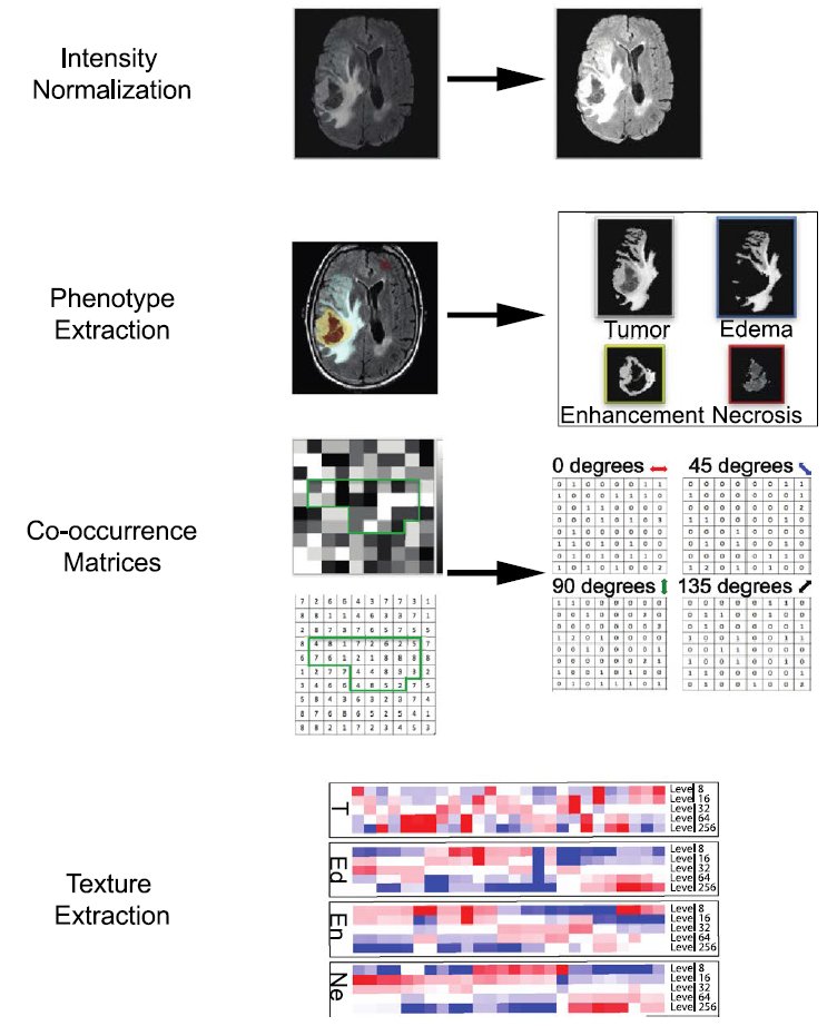 Journal of Neuro-Oncology (@jneurooncol) on Twitter photo A recent study outline a radiomics pipeline which has the potential to pre-operatively discriminate common genetic alterations & identify #GBM patients with favorable survival. <a href="/pascalzinn/">Pascal Zinn, M.D., Ph.D., FAANS</a> <a href="/PittNeurosurg/">Pitt Neurosurgery</a> @drmuratak <a href="/serafettnznkn/">Serafettin Zenkin, MD</a> <a href="/PittRadiology/">UPMC Radiology</a> <a href="/rrcolen/">Rivka R Colen</a>
link.springer.com/article/10.100… A recent study outline a radiomics pipeline which has the potential to pre-operatively discriminate common genetic alterations & identify #GBM patients with favorable survival. <a href="/pascalzinn/">Pascal Zinn, M.D., Ph.D., FAANS</a> <a href="/PittNeurosurg/">Pitt Neurosurgery</a> @drmuratak <a href="/serafettnznkn/">Serafettin Zenkin, MD</a> <a href="/PittRadiology/">UPMC Radiology</a> <a href="/rrcolen/">Rivka R Colen</a>
link.springer.com/article/10.100…