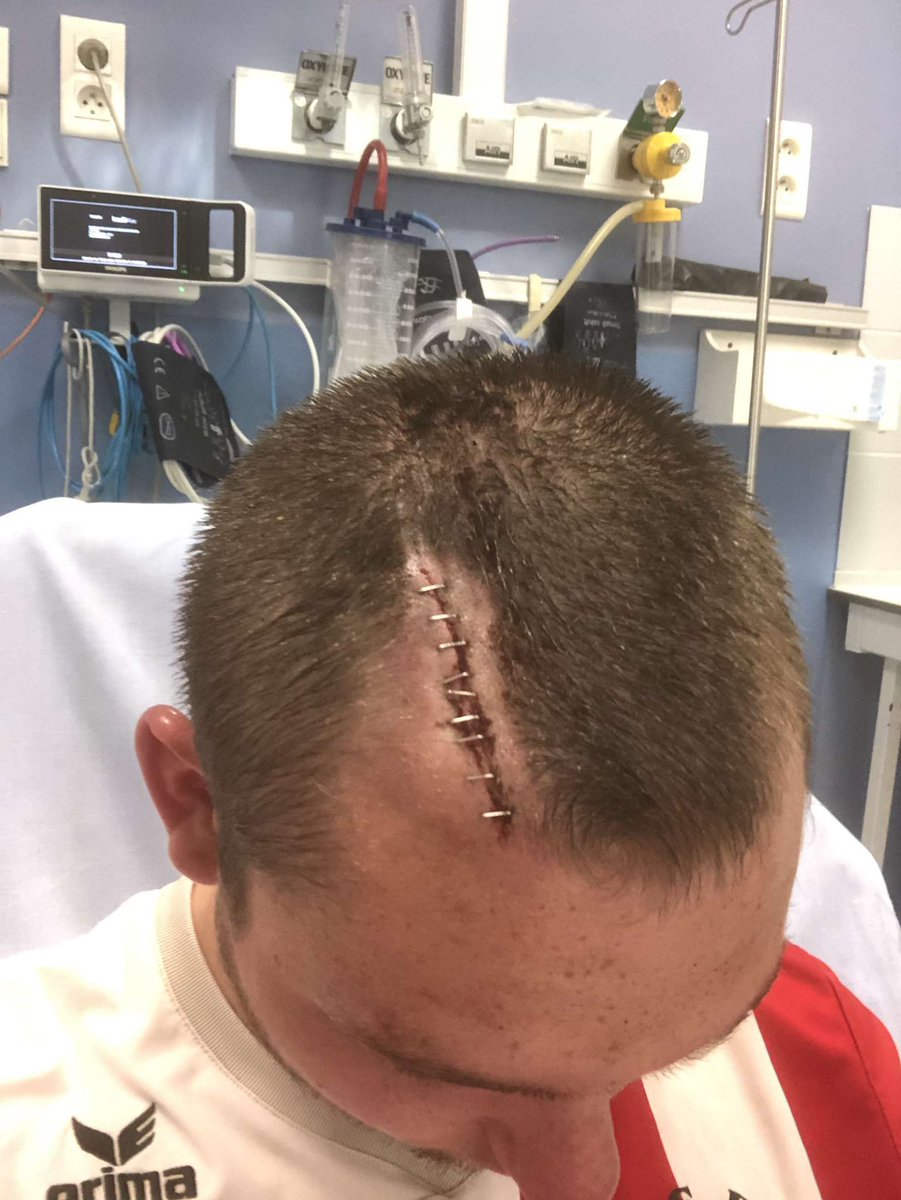 brybrytech's tweet photo. @Maxouks J’ai joué un match de foot et j’ai voulu attrapé une balle en l’air sauf que j’étais giga en retard, j’ai mis un coup de boule au mec adverse. On est tombé et voilà ma tête après le choc et l’autre a eu un cocard et une cicatrice à l’arcade https://t.co/TPsWvWPJn0