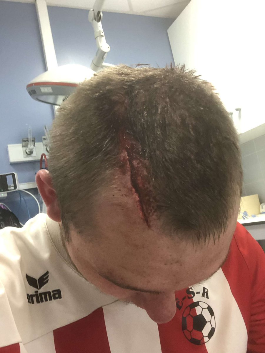 brybrytech's tweet photo. @Maxouks J’ai joué un match de foot et j’ai voulu attrapé une balle en l’air sauf que j’étais giga en retard, j’ai mis un coup de boule au mec adverse. On est tombé et voilà ma tête après le choc et l’autre a eu un cocard et une cicatrice à l’arcade https://t.co/TPsWvWPJn0