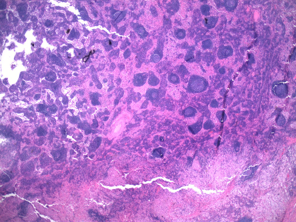 mark_girton's tweet photo. ~40 yo M inguinal lymph node at low, medium, and high power magnification.  Pertinent findings and differential diagnosis? https://t.co/EKNNf6oeI8