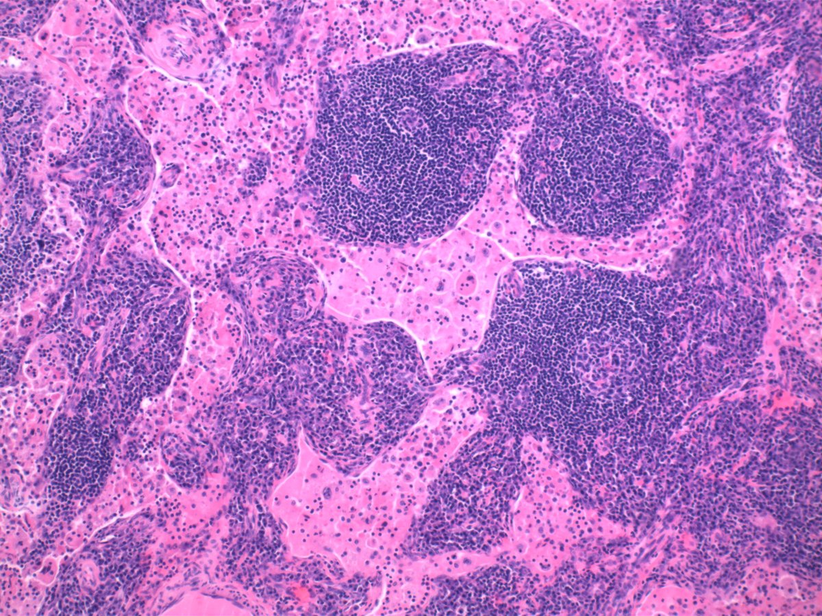 mark_girton's tweet photo. ~40 yo M inguinal lymph node at low, medium, and high power magnification.  Pertinent findings and differential diagnosis? https://t.co/EKNNf6oeI8